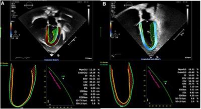 Case report: Epstein–Barr virus and constrictive pericarditis—An unusual combination